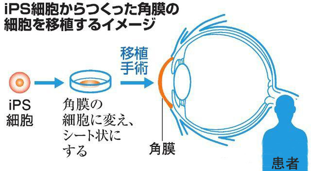 角膜细胞移植