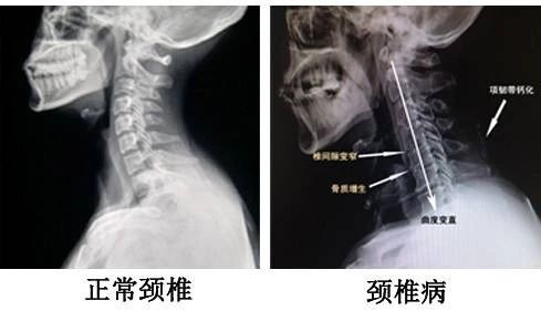 颈椎病