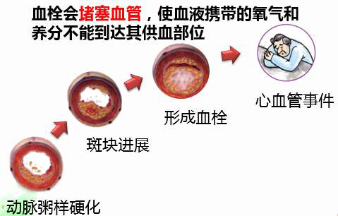 心血管疾病