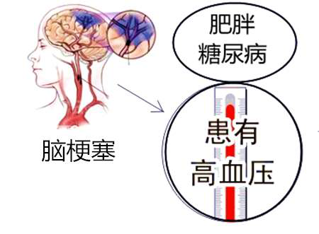 脑血栓